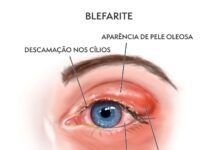 Aumento de Olho Seco por infestação de ácaros
