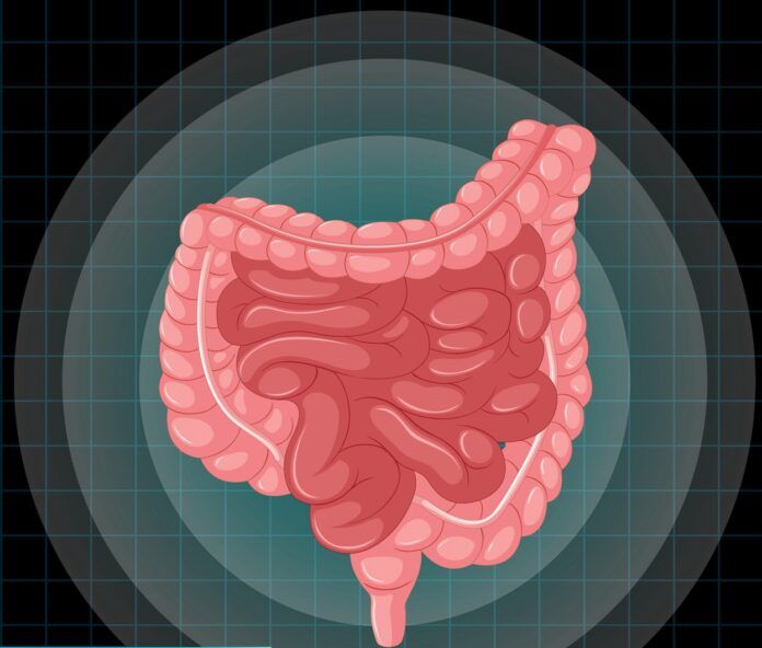 Câncer de intestino: a detecção precoce é fundamental para o tratamento e a cura