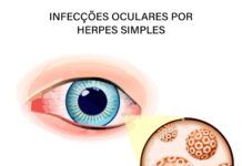 Infecções oculares por Herpes Simples têm tratamento