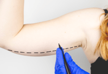 Lipoaspiração é a cirurgia plástica mais comum no Brasil, segundo pesquisa