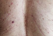 Cicatrizes pós-cirurgia plástica têm tratamento