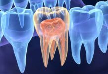 Endodontia ganha espaço na saúde pública nacional
