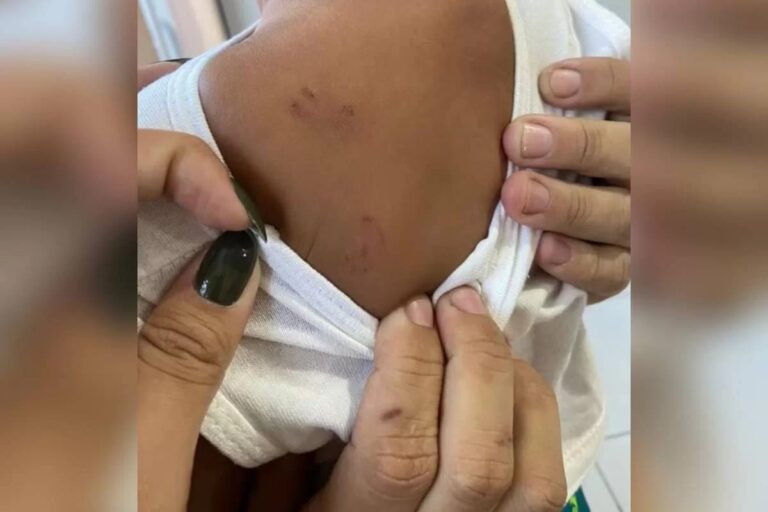 POLÍCIA: Bebê de 11 meses é atacado com nove mordidas em creche; Família denuncia caso