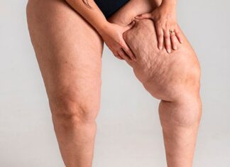 sintomas do lipedema