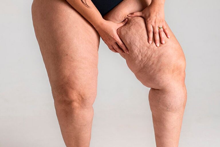 sintomas do lipedema
