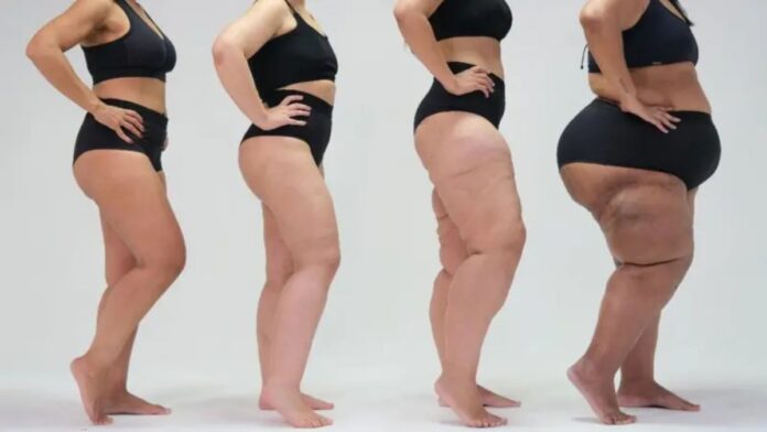 mulheres com lipedema