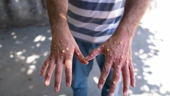 sintomas mpox