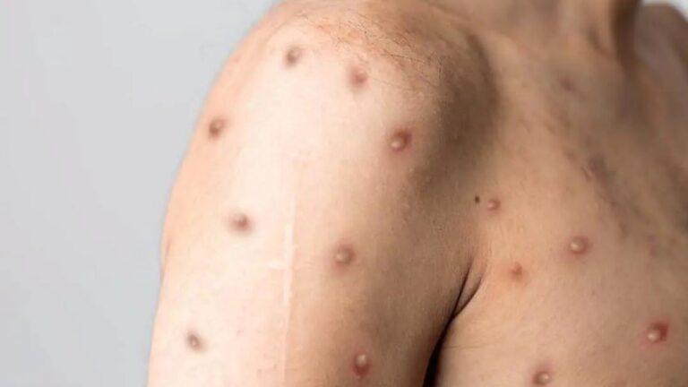 Cantor morre varíola dos macacos