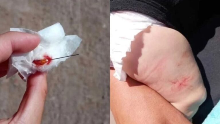 bebê tem agulha esquecida em perna por enfermeiro