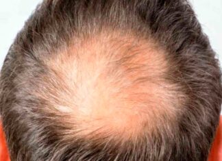 Minoxidil calvície