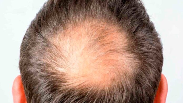Minoxidil calvície