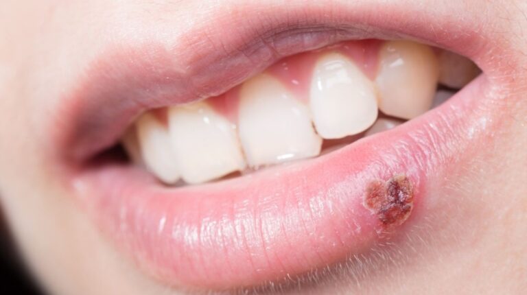 Feridas na boca; quando os níveis de açúcar no sangue estão elevados, o corpo emite sinais claros que não devem ser ignorados;
