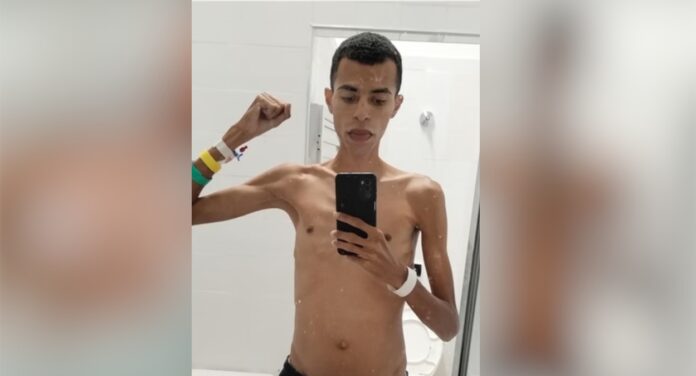 Jovem perde 25kg por causa da doença de cronh