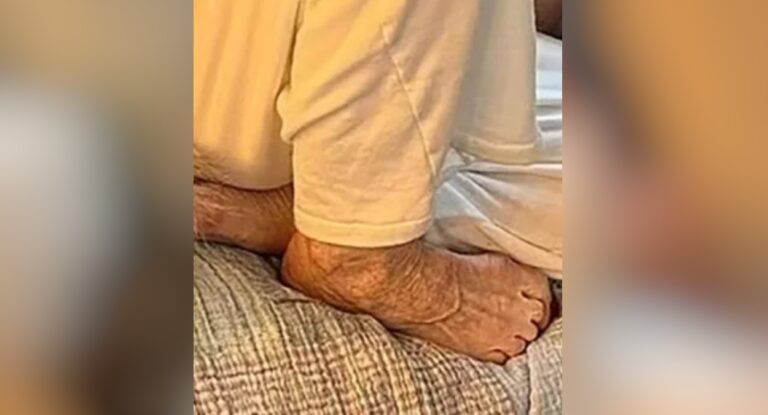 Entenda o que é o pé de ozempic