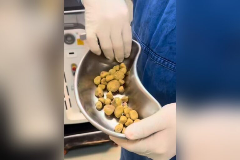 pedras nos rins e na bexiga