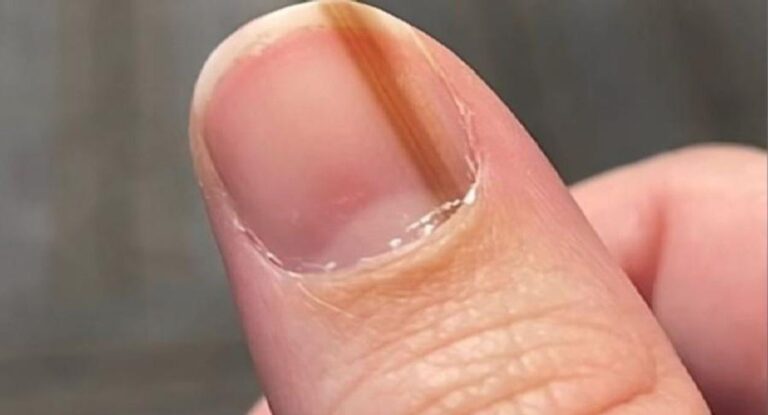 Foto mostra alterações na unha que podem sinalizar câncer