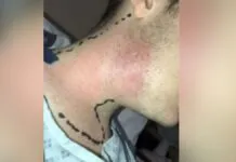 Jovem passa por cirurgia de emergência após espremer espinha