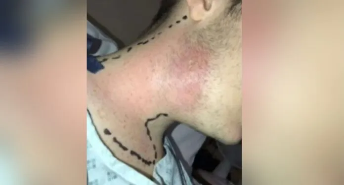 Jovem passa por cirurgia de emergência após espremer espinha