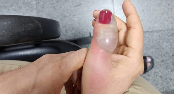 Imagem do dedo de Marise Teixeira completamente enchado