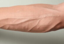 Imagem de um braço com veias saltadas