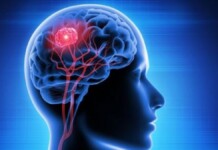 imagem de ilustração de um tumor cerebral