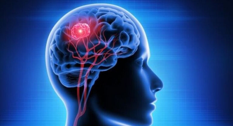 imagem de ilustração de um tumor cerebral