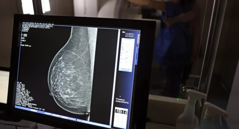 foto de exame de mamografia