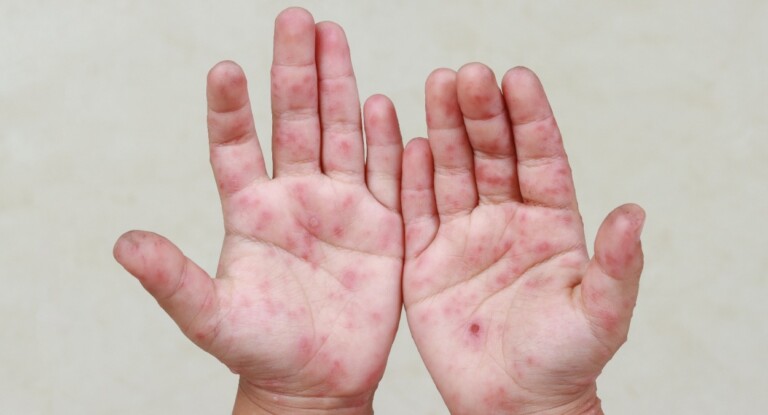 na foto, criança com a síndrome mão-pé-boca