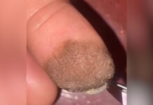Mulher compartilha reação ao ter pelos pubianos crescendo no dedo enxertado