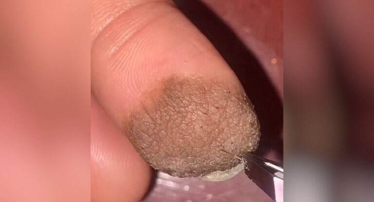 Mulher compartilha reação ao ter pelos pubianos crescendo no dedo enxertado