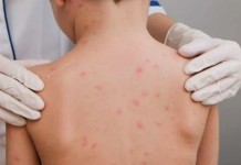 Cidade do RS tem novo surto de meningite na foto, cidade surto de meningite