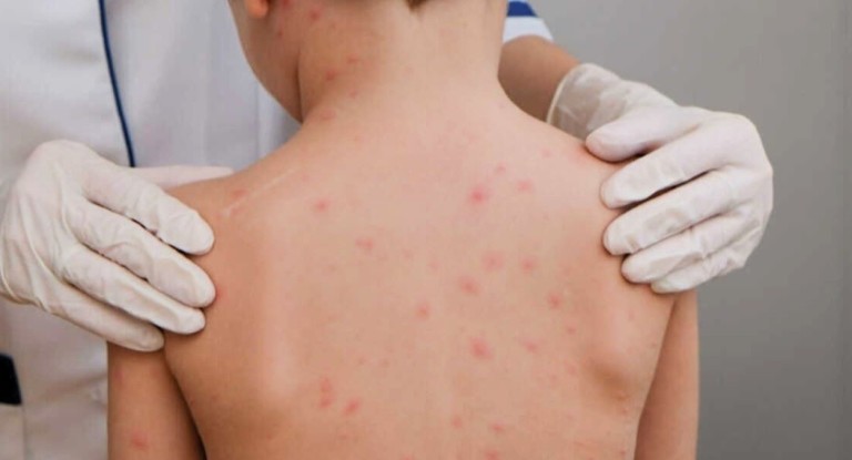 na foto, cidade surto de meningite