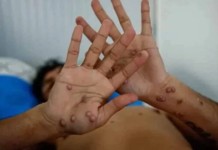 Confirmado primeiro caso de Mpox de 2026 em Porto Alegre Confirmado primeiro caso de Mpox de 2026 em Porto AlegreEm 2025