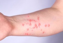 Mpox em Porto Alegre: capital confirma primeiro caso e alerta para formas de contágio