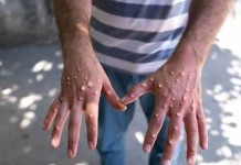 Mpox: Brasil chega a quase 100 casos em 2026; saiba os principais sintomas