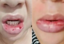 Mulher tem reação com pasta de dente Colgate e perde processo na Justiça Mulher tem reação com pasta de dente Colgate e perde processo na Justiça