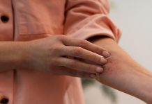 Mosquitos parecem escolher vítimas? Entenda por que algumas pessoas são picadas muito mais que outras e como driblar essa condição