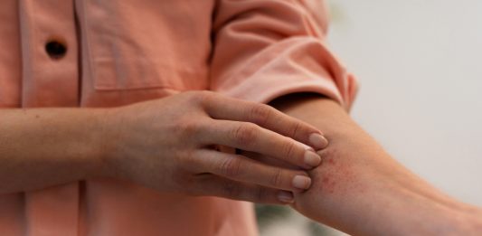 Mosquitos parecem escolher vítimas? Entenda por que algumas pessoas são picadas muito mais que outras e como driblar essa condição